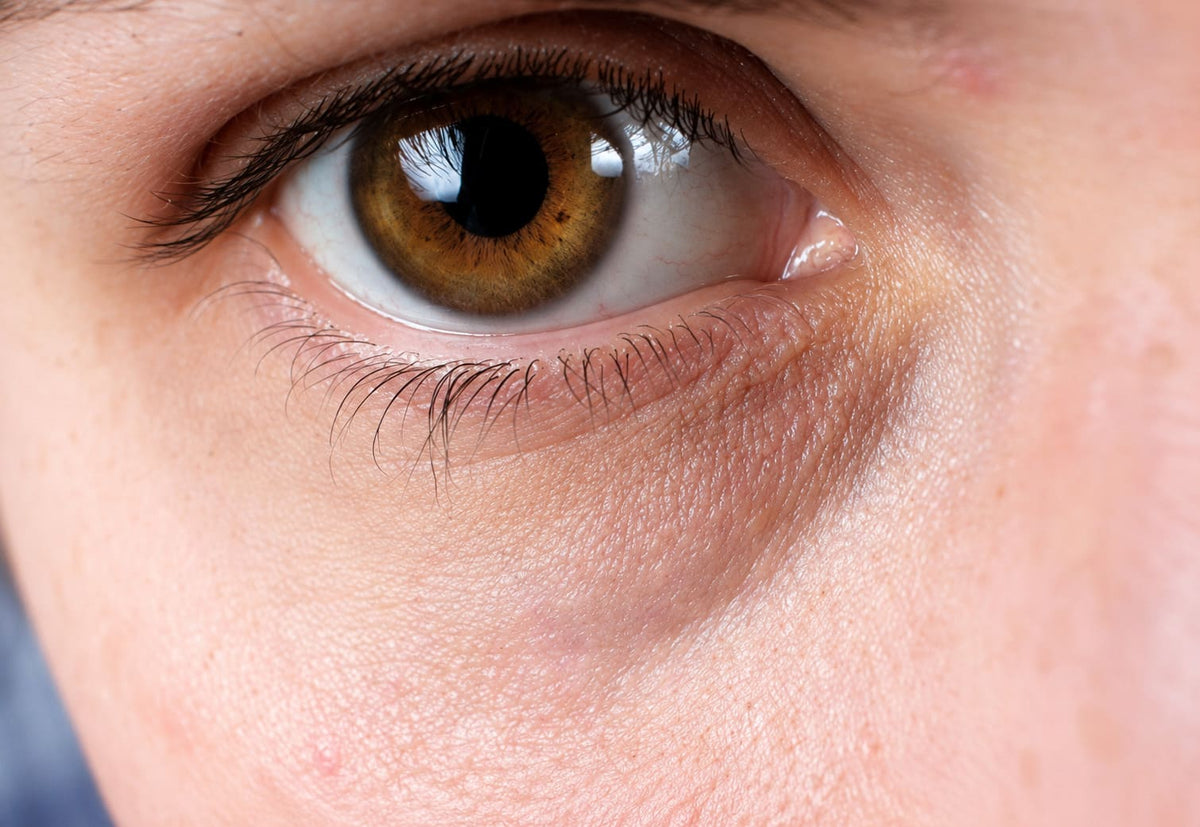 Contorno de ojos antes